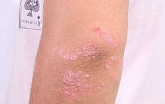 10 Things one must be Aware of Psoriasis