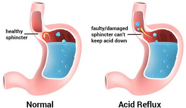 Symptoms, Natural Treatment and Diet for Acid Reflux